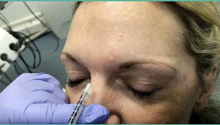 Botox filler dermal injections procedures surgery