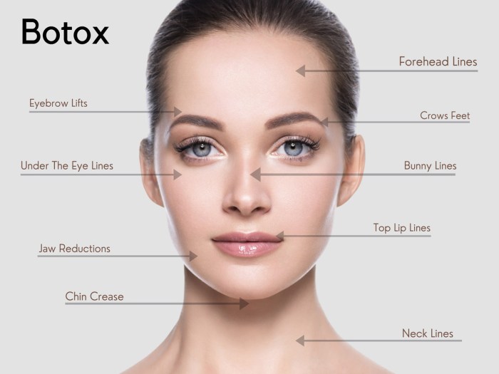 Botox