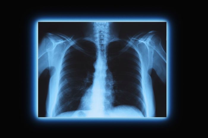 What are three advantages of digital x-rays over film